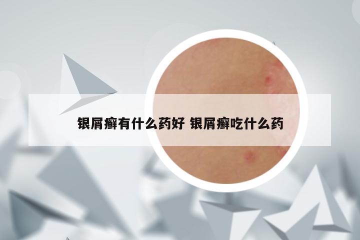 银屑癣有什么药好 银屑癣吃什么药