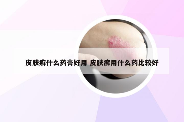 皮肤癣什么药膏好用 皮肤癣用什么药比较好