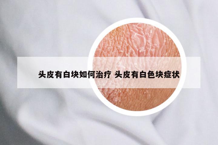头皮有白块如何治疗 头皮有白色块症状