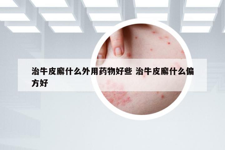 治牛皮廨什么外用药物好些 治牛皮廨什么偏方好