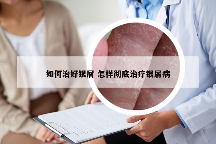 如何治好银屑 怎样彻底治疗银屑病