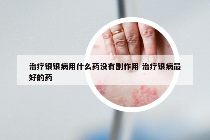 治疗银银病用什么药没有副作用 治疗银病最好的药