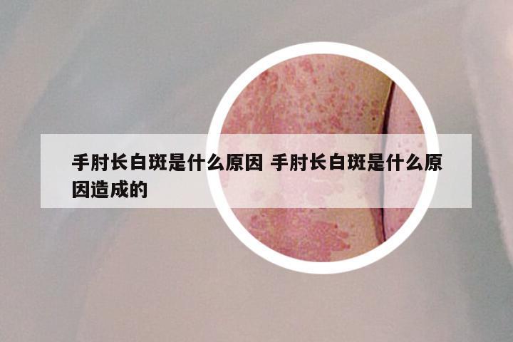手肘长白斑是什么原因 手肘长白斑是什么原因造成的