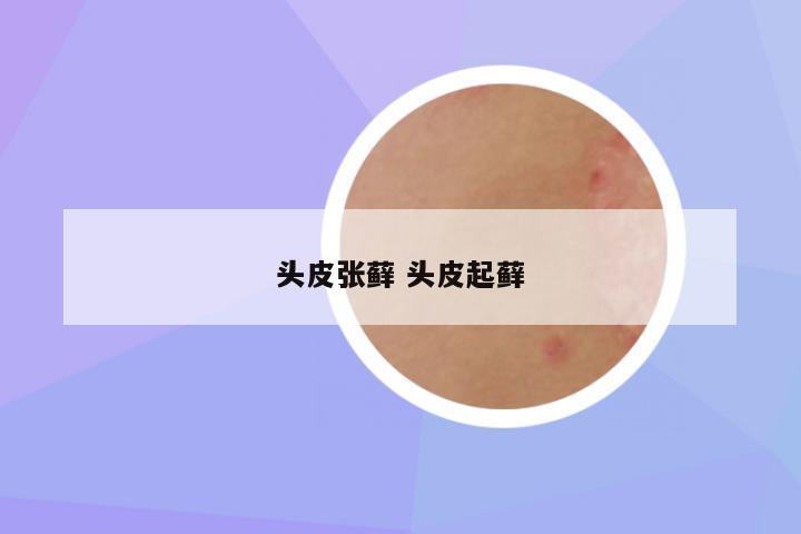 头皮张藓 头皮起藓