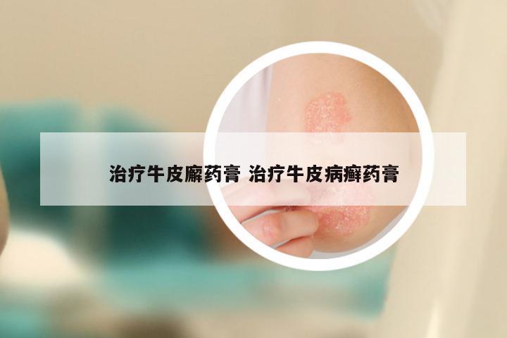 治疗牛皮廨药膏 治疗牛皮病癣药膏