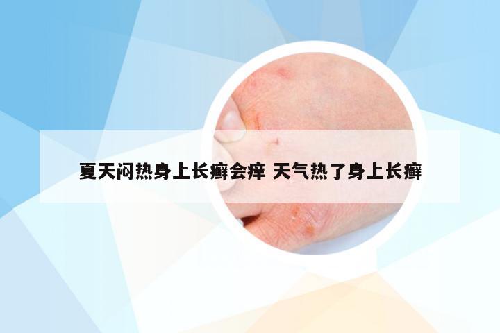 夏天闷热身上长癣会痒 天气热了身上长癣