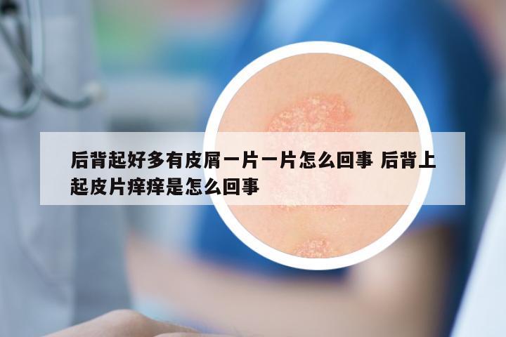 后背起好多有皮屑一片一片怎么回事 后背上起皮片痒痒是怎么回事