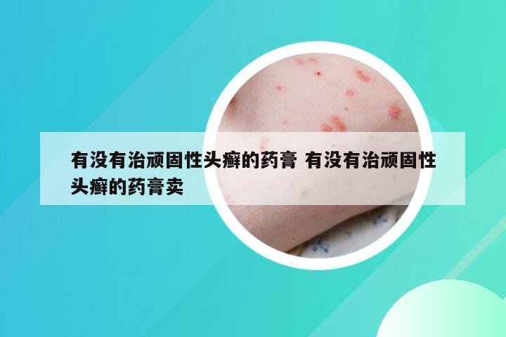 有没有治顽固性头癣的药膏 有没有治顽固性头癣的药膏卖