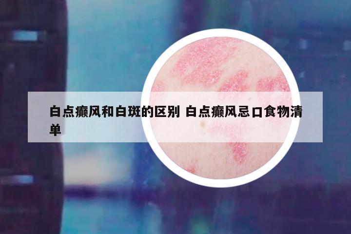白点癫风和白斑的区别 白点癫风忌口食物清单