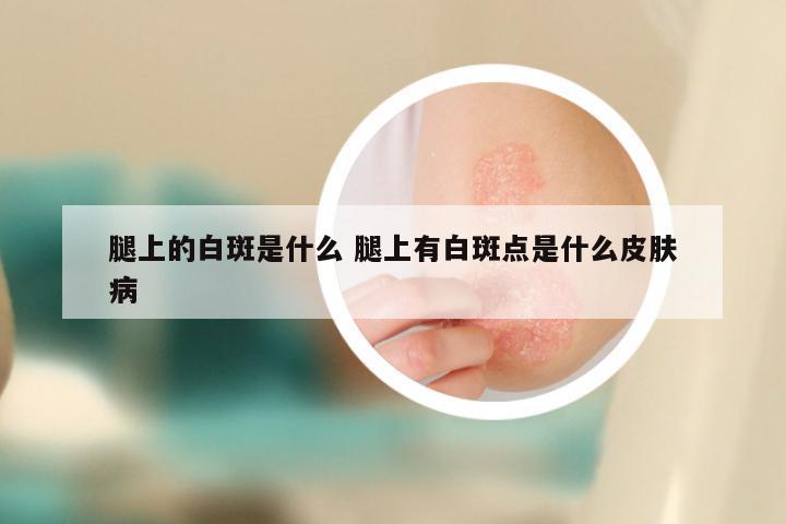 腿上的白斑是什么 腿上有白斑点是什么皮肤病