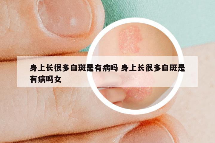 身上长很多白斑是有病吗 身上长很多白斑是有病吗女