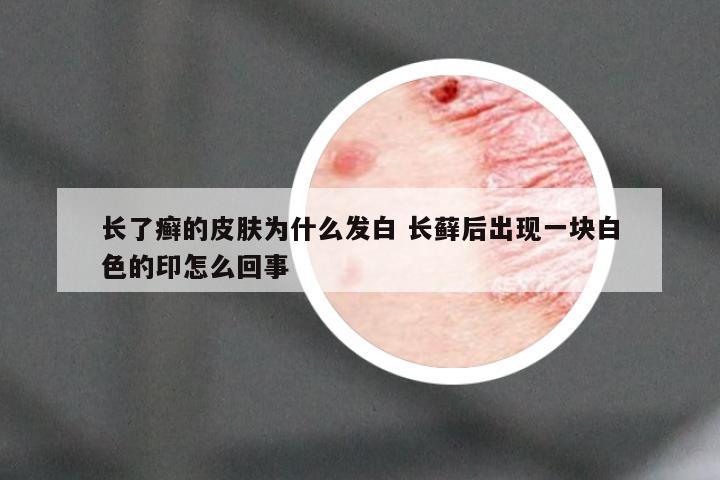 长了癣的皮肤为什么发白 长藓后出现一块白色的印怎么回事
