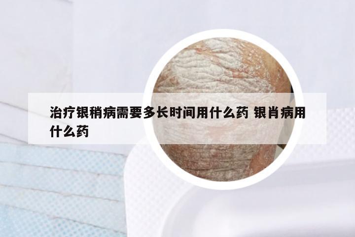 治疗银稍病需要多长时间用什么药 银肖病用什么药
