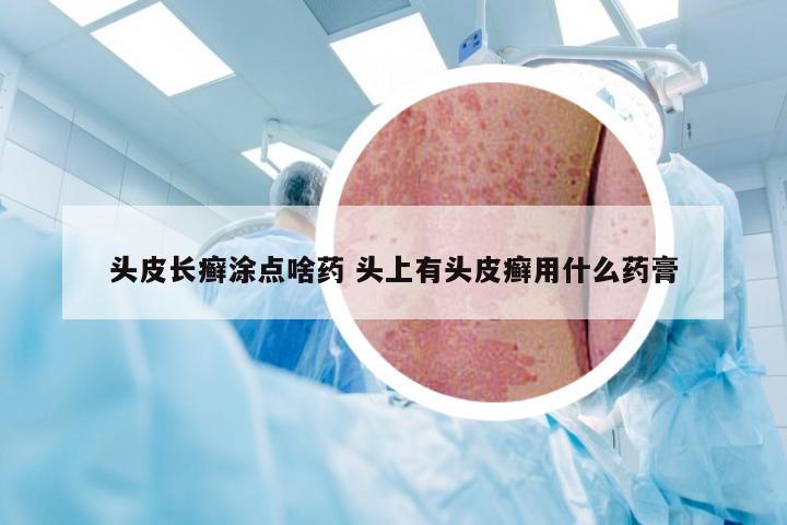 头皮长癣涂点啥药 头上有头皮癣用什么药膏