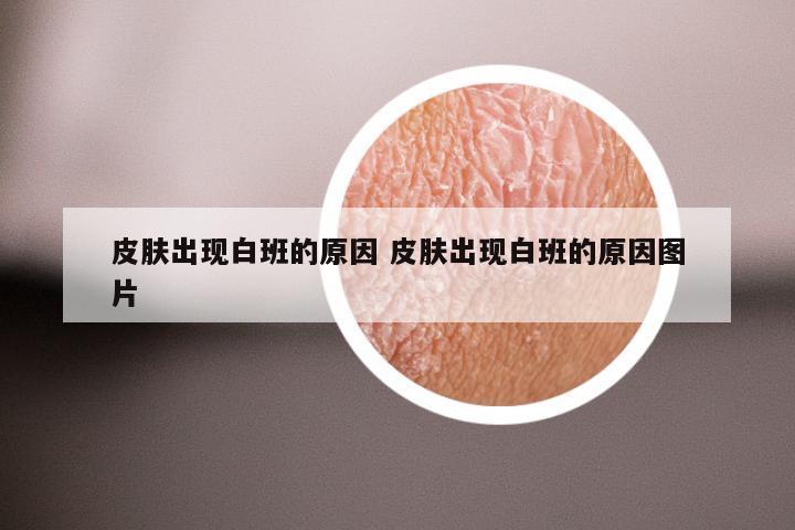 皮肤出现白班的原因 皮肤出现白班的原因图片