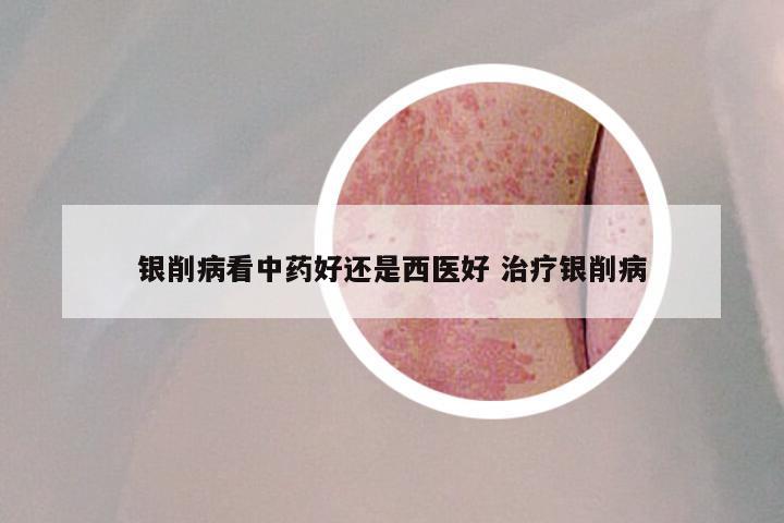银削病看中药好还是西医好 治疗银削病