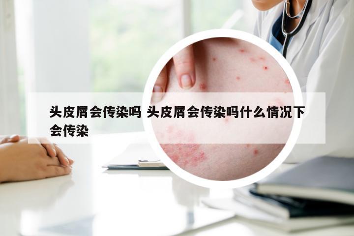 头皮屑会传染吗 头皮屑会传染吗什么情况下会传染