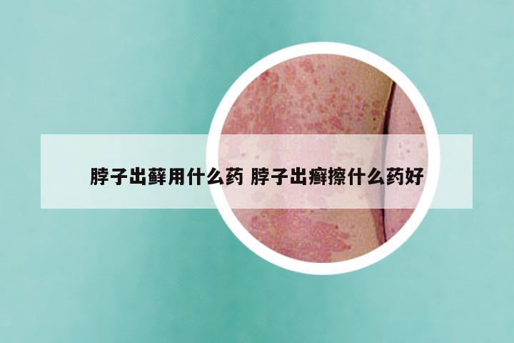 脖子出藓用什么药 脖子出癣擦什么药好
