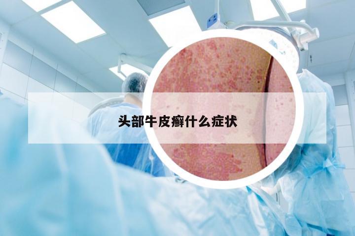 头部牛皮癣什么症状