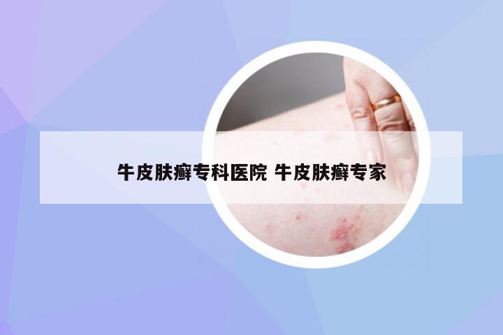 牛皮肤癣专科医院 牛皮肤癣专家