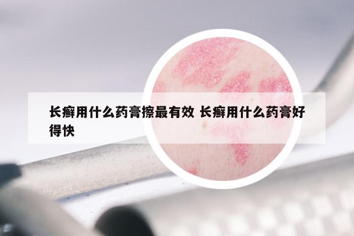 长癣用什么药膏擦最有效 长癣用什么药膏好得快