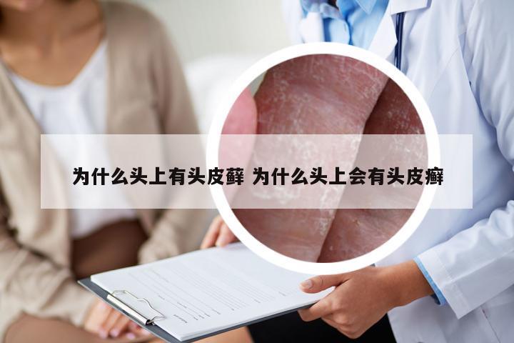 为什么头上有头皮藓 为什么头上会有头皮癣