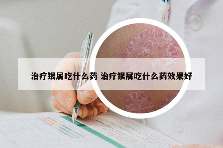 治疗银屑吃什么药 治疗银屑吃什么药效果好