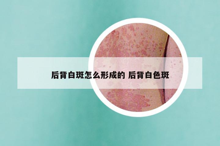 后背白斑怎么形成的 后背白色斑
