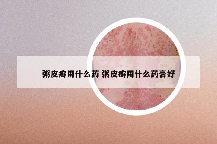粥皮癣用什么药 粥皮癣用什么药膏好