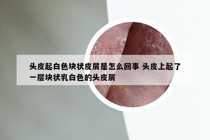 头皮起白色块状皮屑是怎么回事 头皮上起了一层块状乳白色的头皮屑