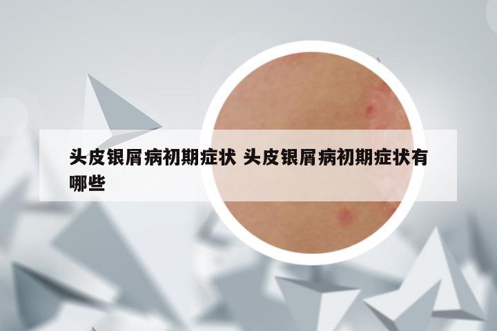 头皮银屑病初期症状 头皮银屑病初期症状有哪些