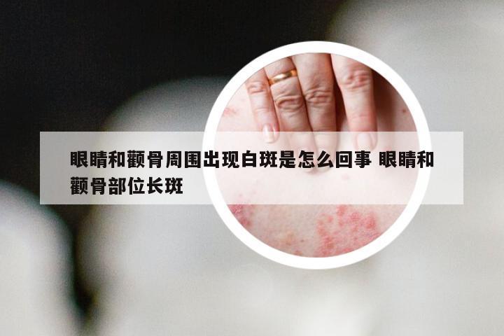 眼睛和颧骨周围出现白斑是怎么回事 眼睛和颧骨部位长斑