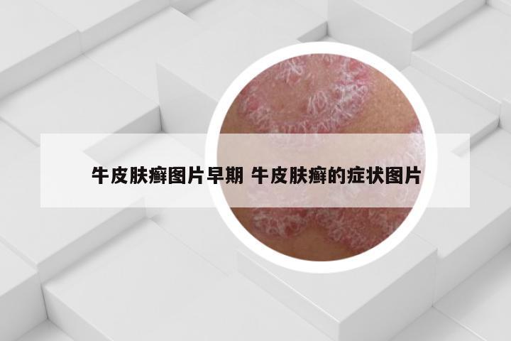 牛皮肤癣图片早期 牛皮肤癣的症状图片