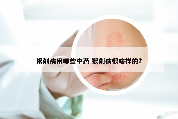 银削病用哪些中药 银削病根啥样的?
