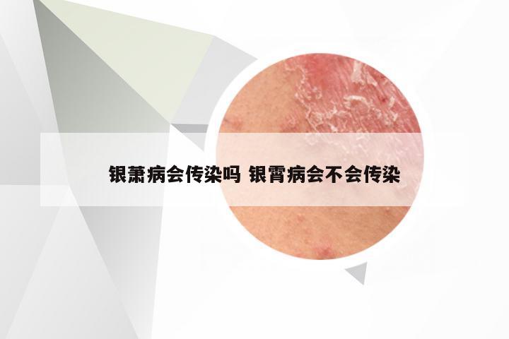 银萧病会传染吗 银霄病会不会传染