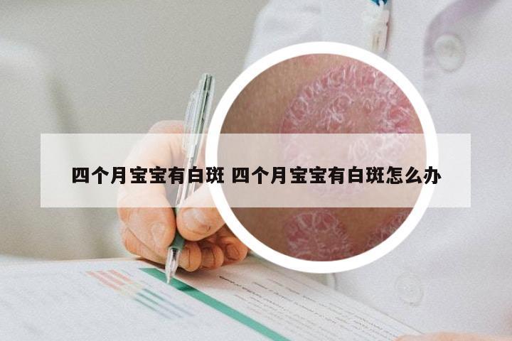 四个月宝宝有白斑 四个月宝宝有白斑怎么办