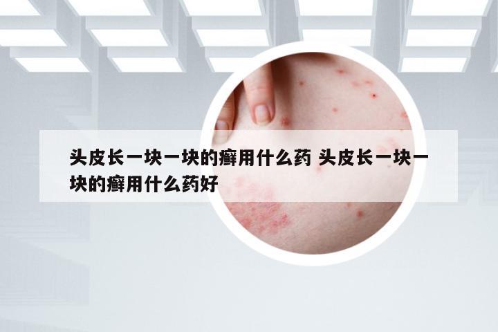 头皮长一块一块的癣用什么药 头皮长一块一块的癣用什么药好