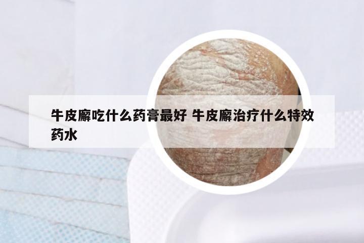 牛皮廨吃什么药膏最好 牛皮廨治疗什么特效药水