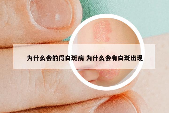 为什么会的得白斑病 为什么会有白斑出现