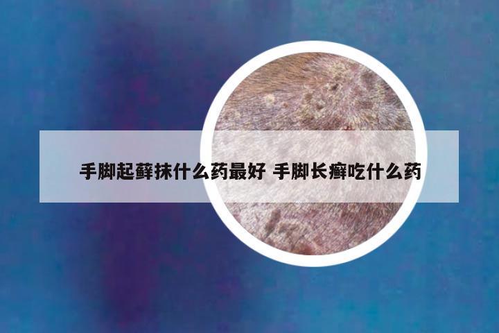 手脚起藓抹什么药最好 手脚长癣吃什么药