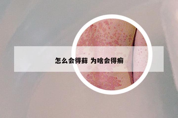 怎么会得藓 为啥会得癣