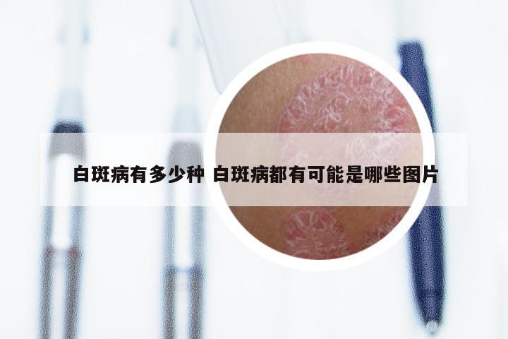 白斑病有多少种 白斑病都有可能是哪些图片