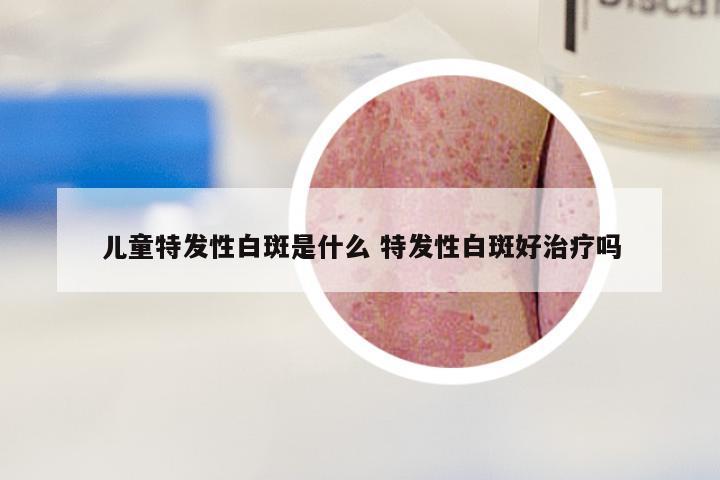 儿童特发性白斑是什么 特发性白斑好治疗吗