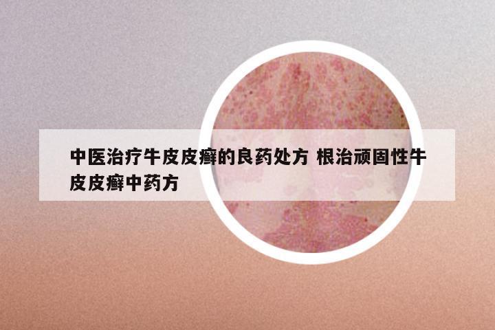 中医治疗牛皮皮癣的良药处方 根治顽固性牛皮皮癣中药方