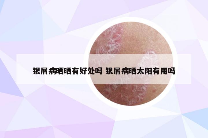银屑病晒晒有好处吗 银屑病晒太阳有用吗