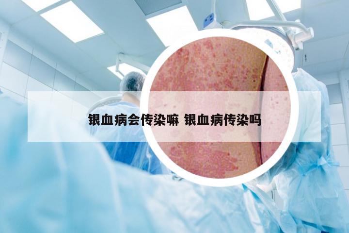 银血病会传染嘛 银血病传染吗