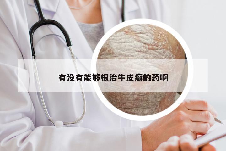 有没有能够根治牛皮癣的药啊