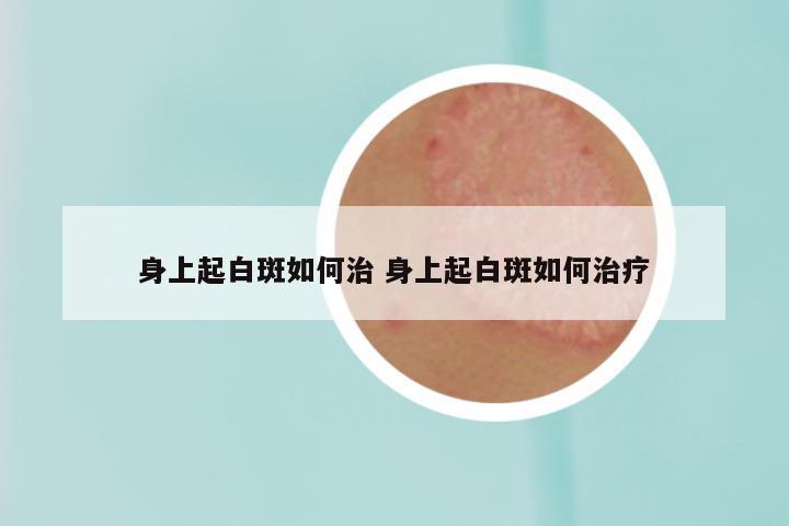 身上起白斑如何治 身上起白斑如何治疗
