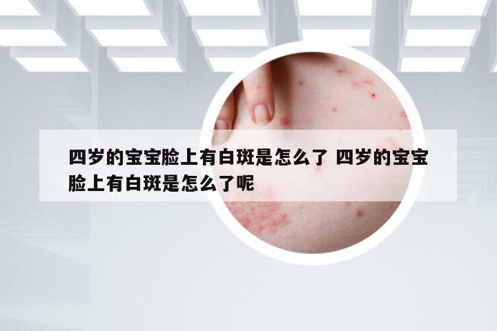 四岁的宝宝脸上有白斑是怎么了 四岁的宝宝脸上有白斑是怎么了呢