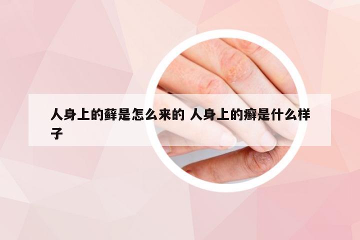 人身上的藓是怎么来的 人身上的癣是什么样子